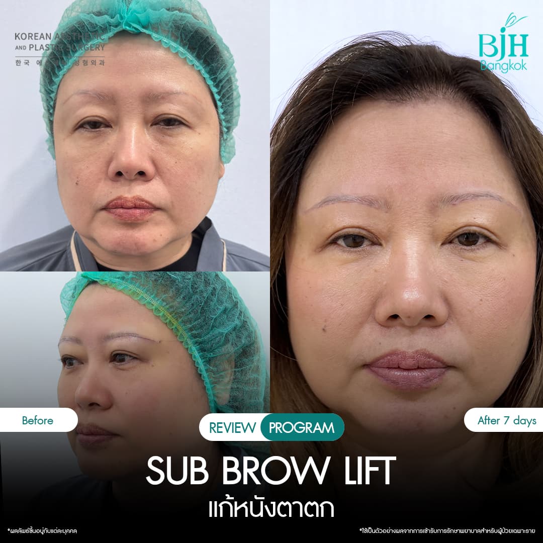 รีวิว Subbrowlift 01