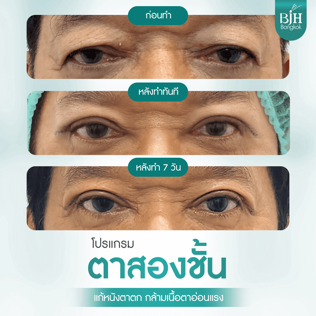 ตาสองชั้น 16
