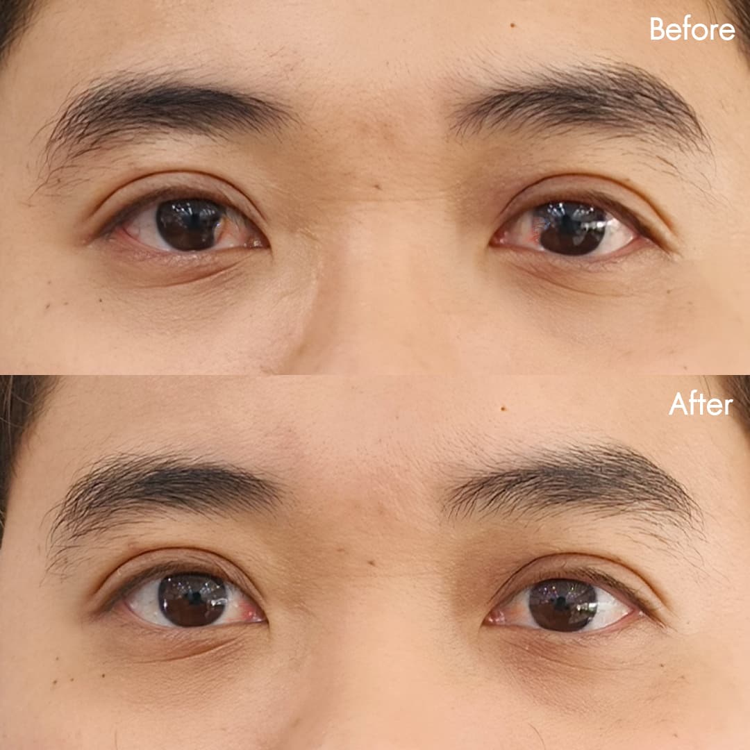 Before&After ลอกต้อเนื้อ(แนน)
