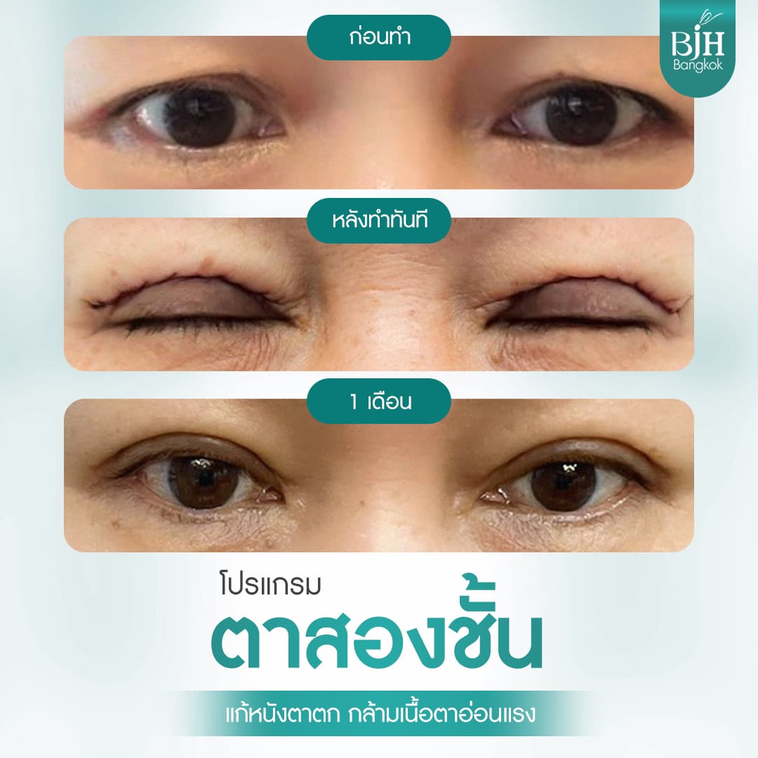 ตาสองชั้น 11