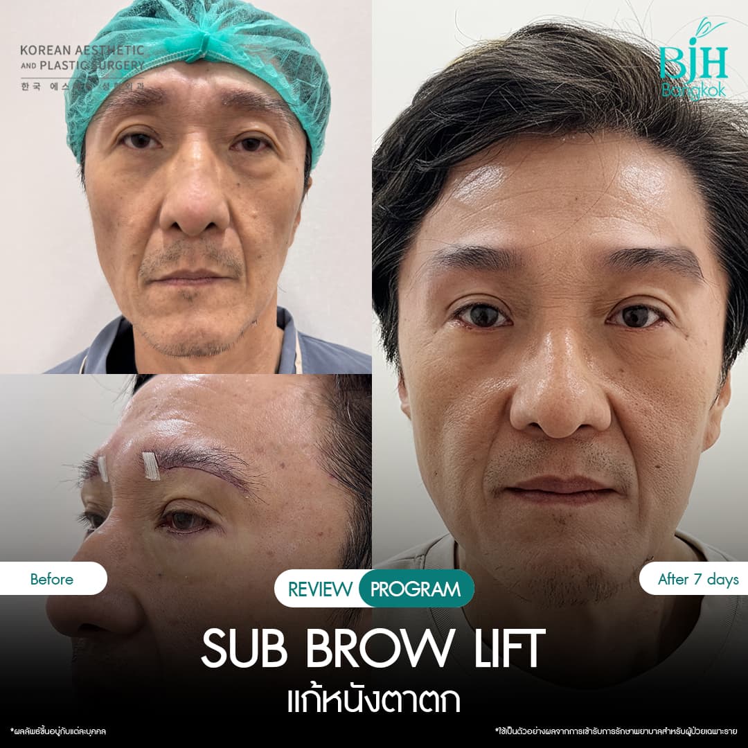 รีวิว Subbrowlift 05