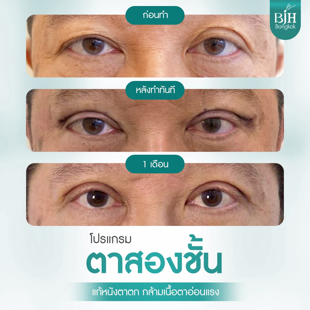 ตาสองชั้น 10
