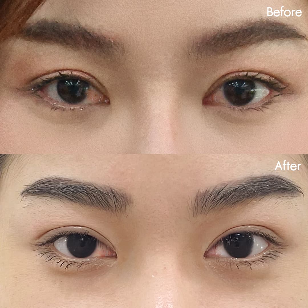 Before&After ลอกต้อเนื้อ(พลอย)