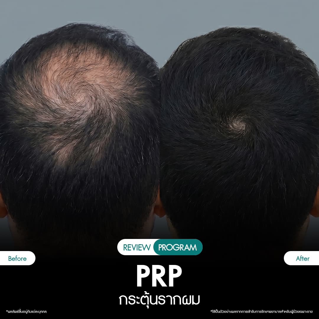 รีวิว ปลูกผม PRP 03