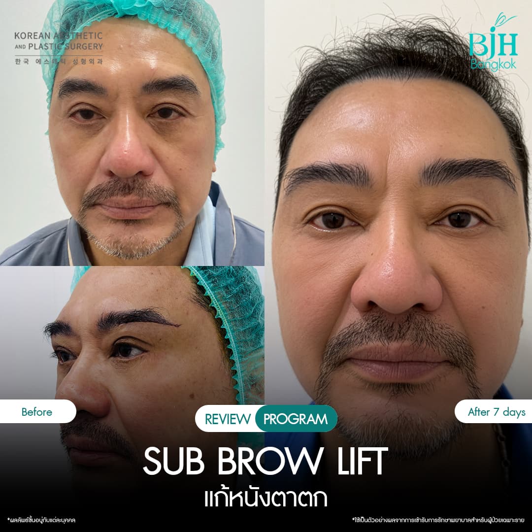 รีวิว Subbrowlift 03
