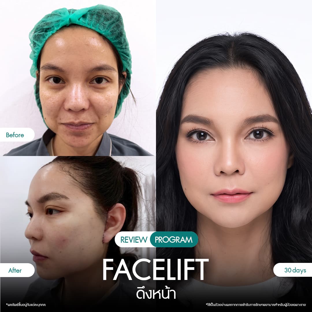 รีวิวดึงหน้า 15