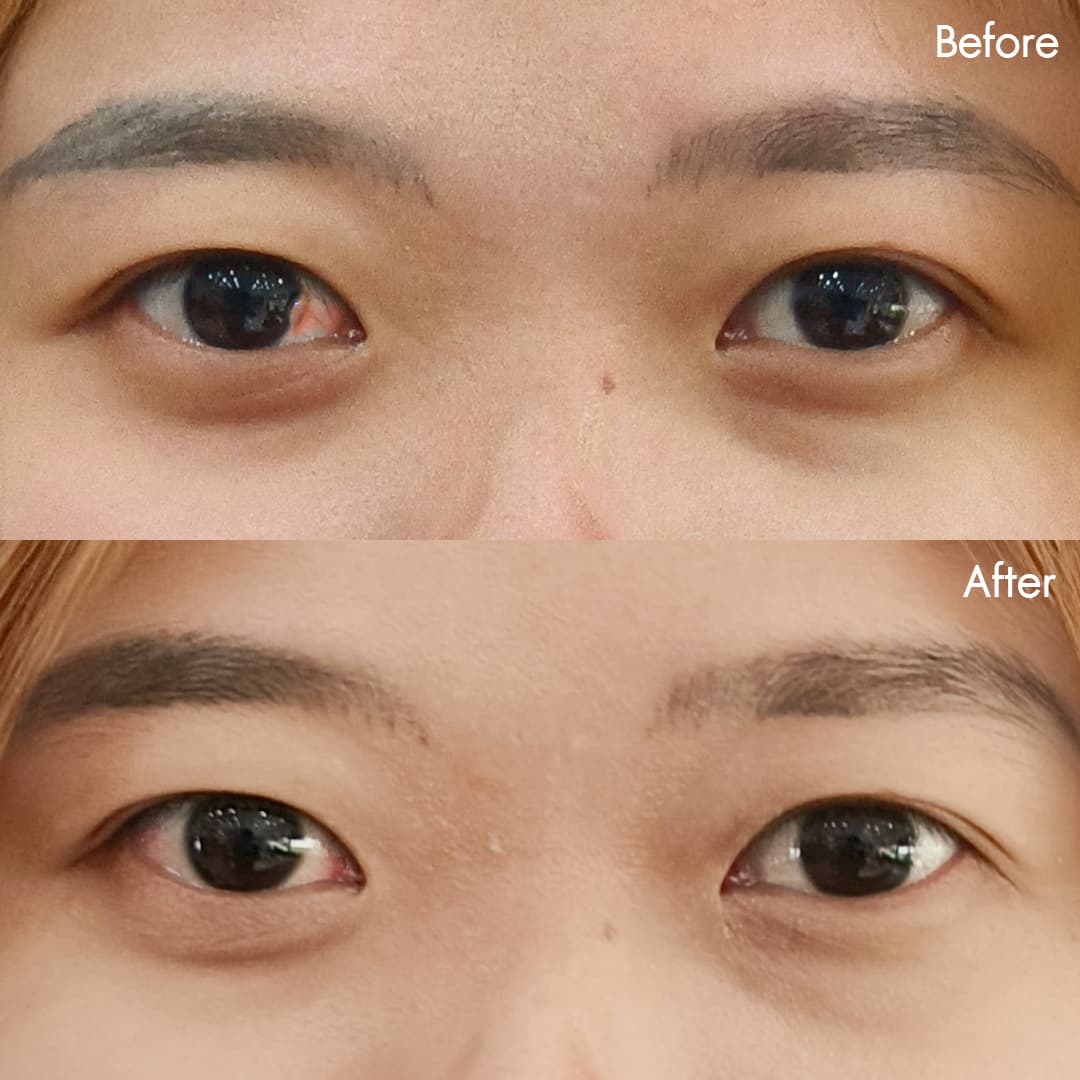 Before&After ลอกต้อเนื้อ(มล)