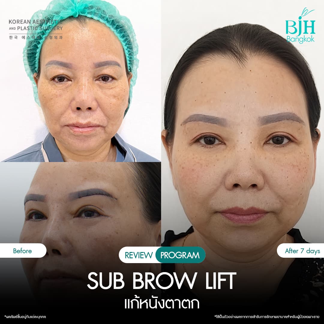 รีวิว Subbrowlift 09