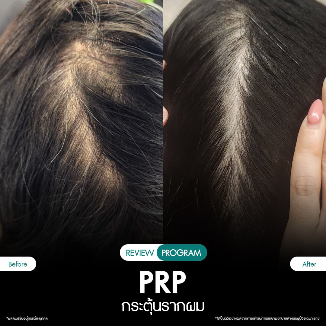รีวิว ปลูกผม PRP 04