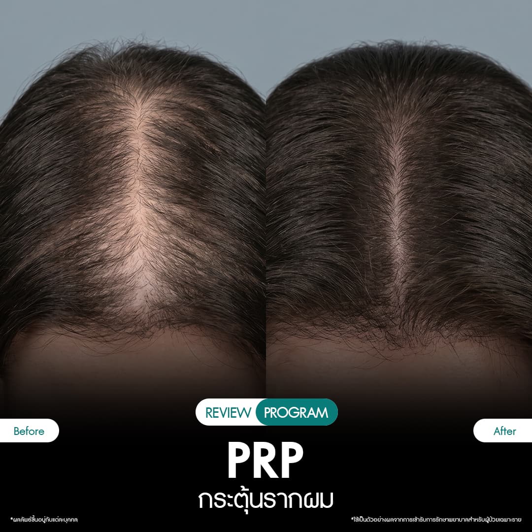 รีวิว ปลูกผม PRP 02