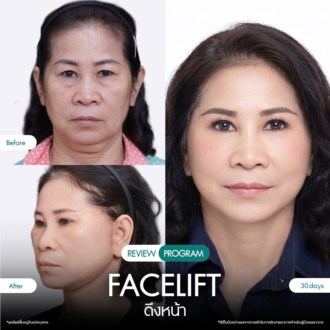 รีวิวดึงหน้า 02