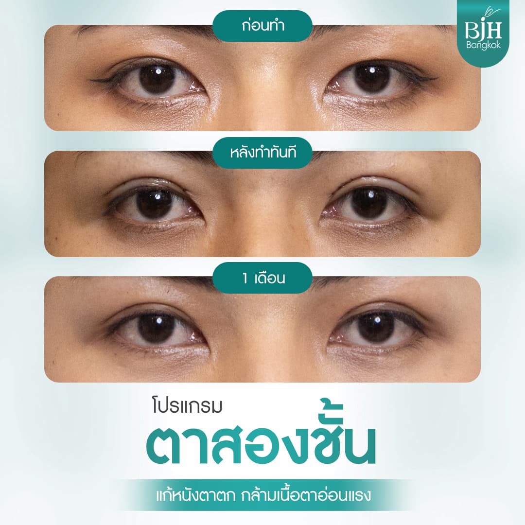 ตาสองชั้น 02