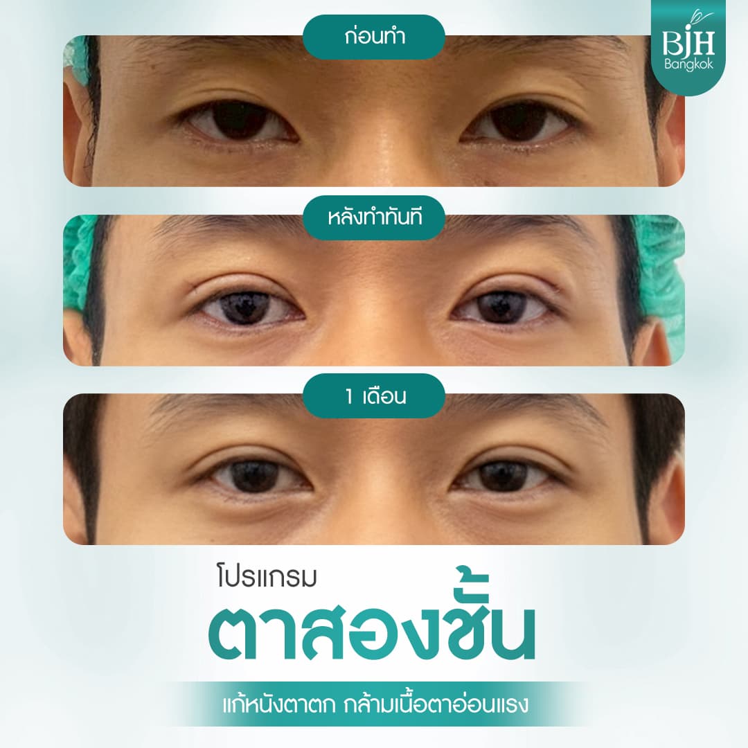 ตาสองชั้น 15