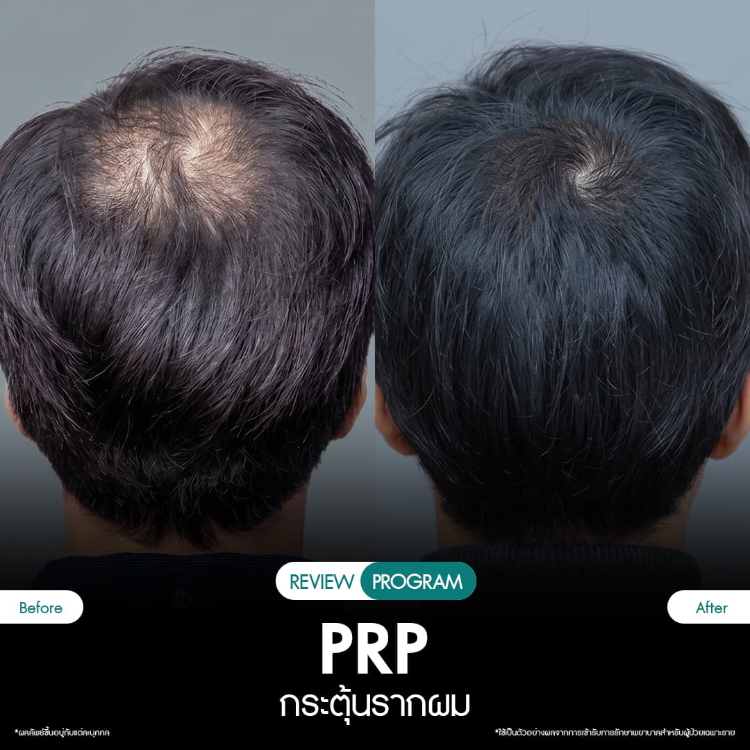 รีวิว ปลูกผม PRP 06