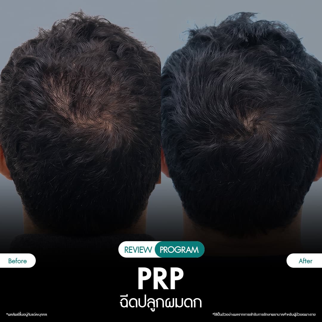 รีวิว ปลูกผม PRP 05