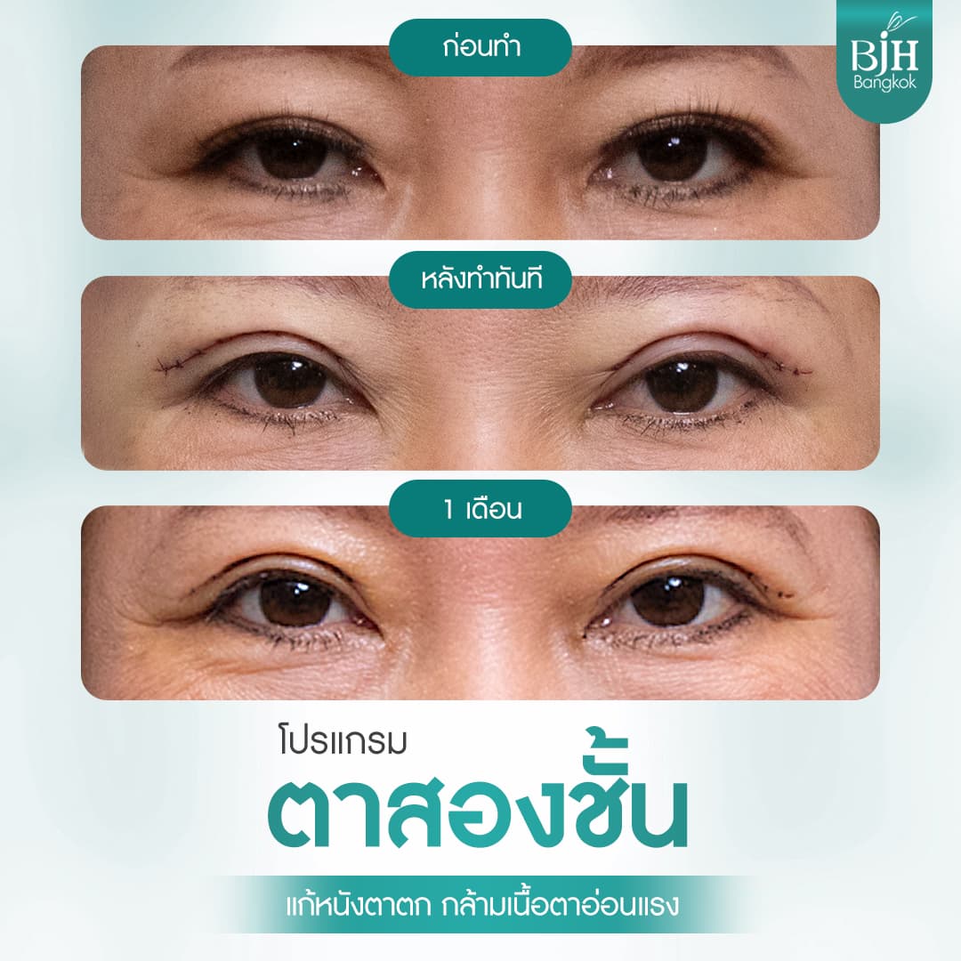 ตาสองชั้น 03