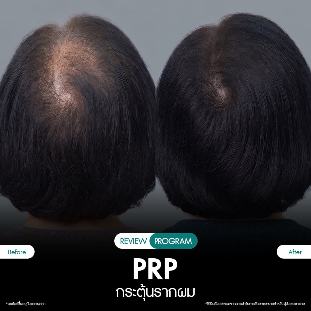 รีวิว ปลูกผม PRP 07