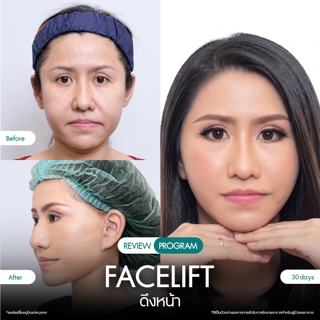 รีวิวดึงหน้า 08