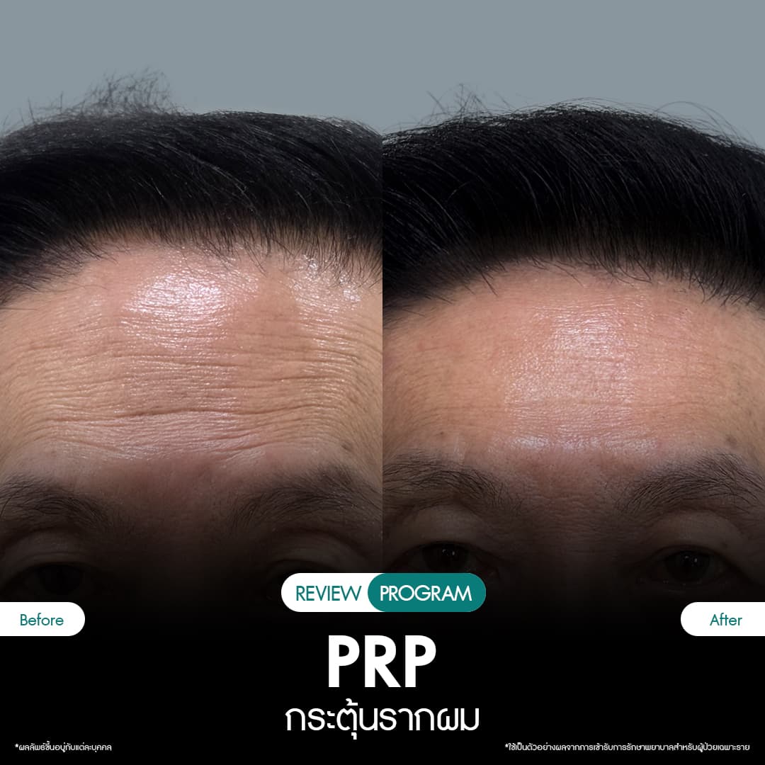 รีวิว ปลูกผม PRP 13