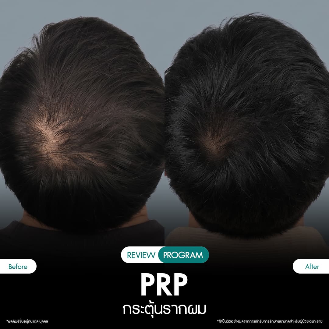 รีวิว ปลูกผม PRP 12