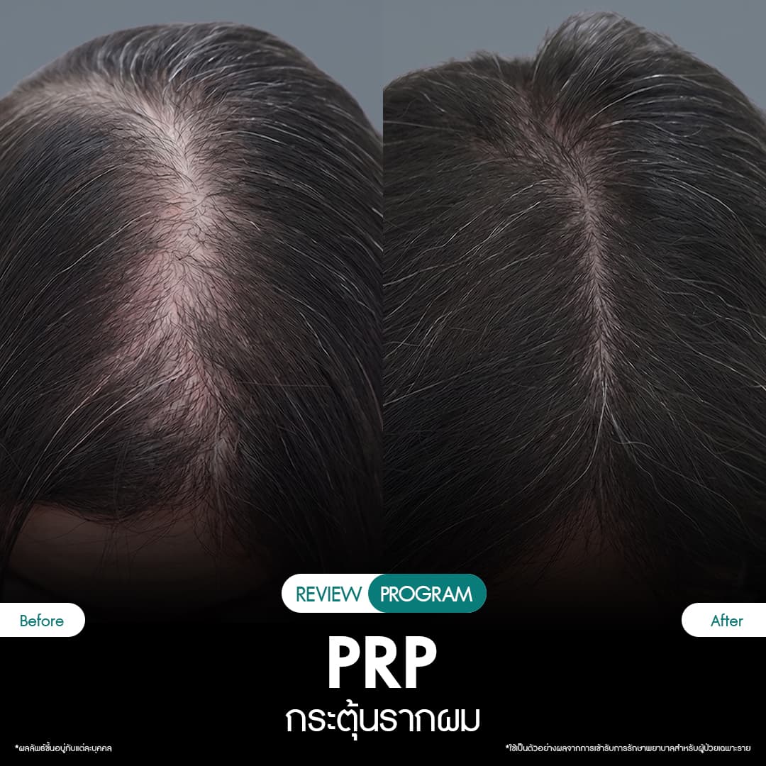 รีวิว ปลูกผม PRP 11