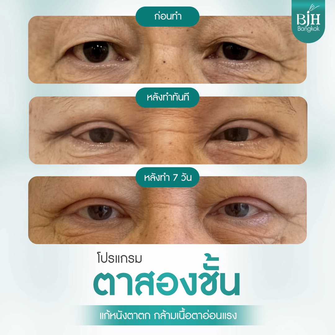 ตาสองชั้น 18