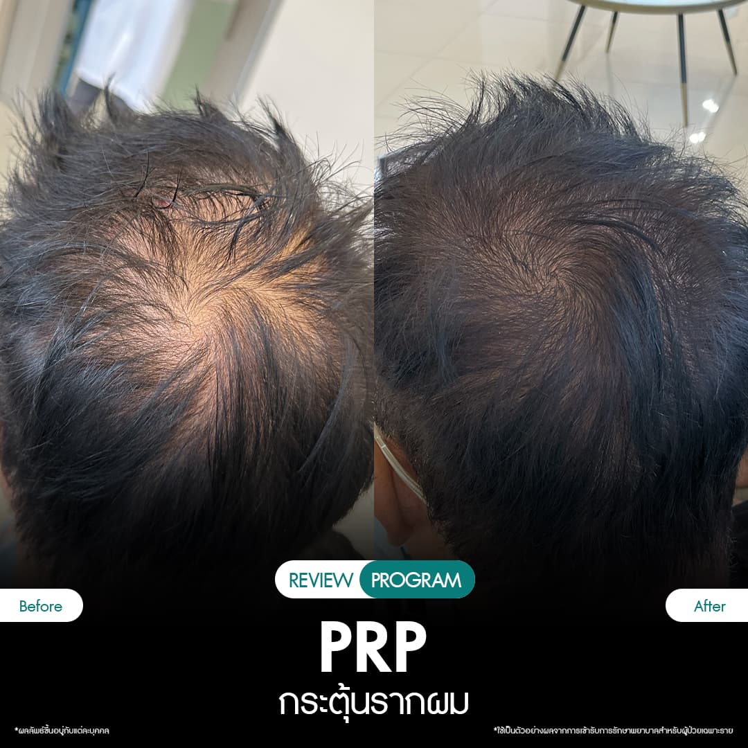 รีวิว ปลูกผม PRP 14