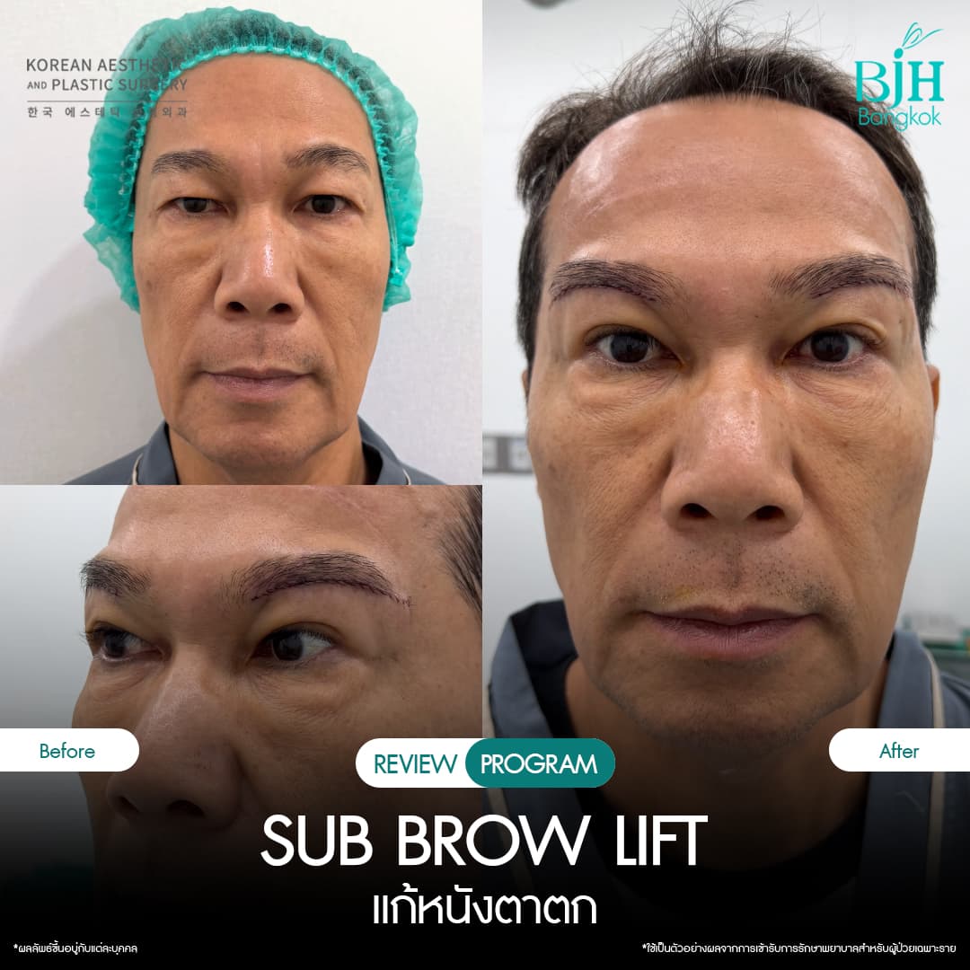 รีวิว Subbrowlift 11