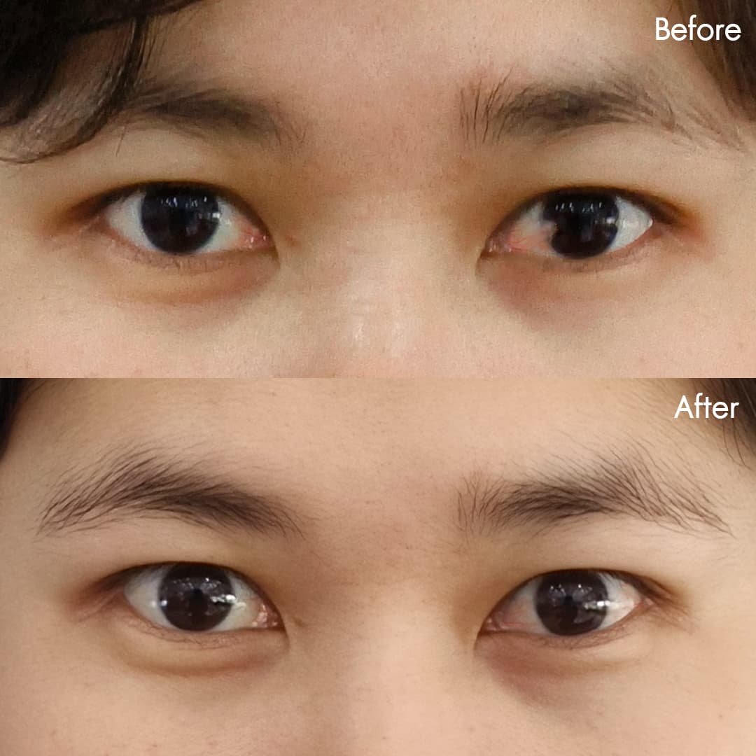 Before&After ลอกต้อเนื้อ(เฟิร์น)