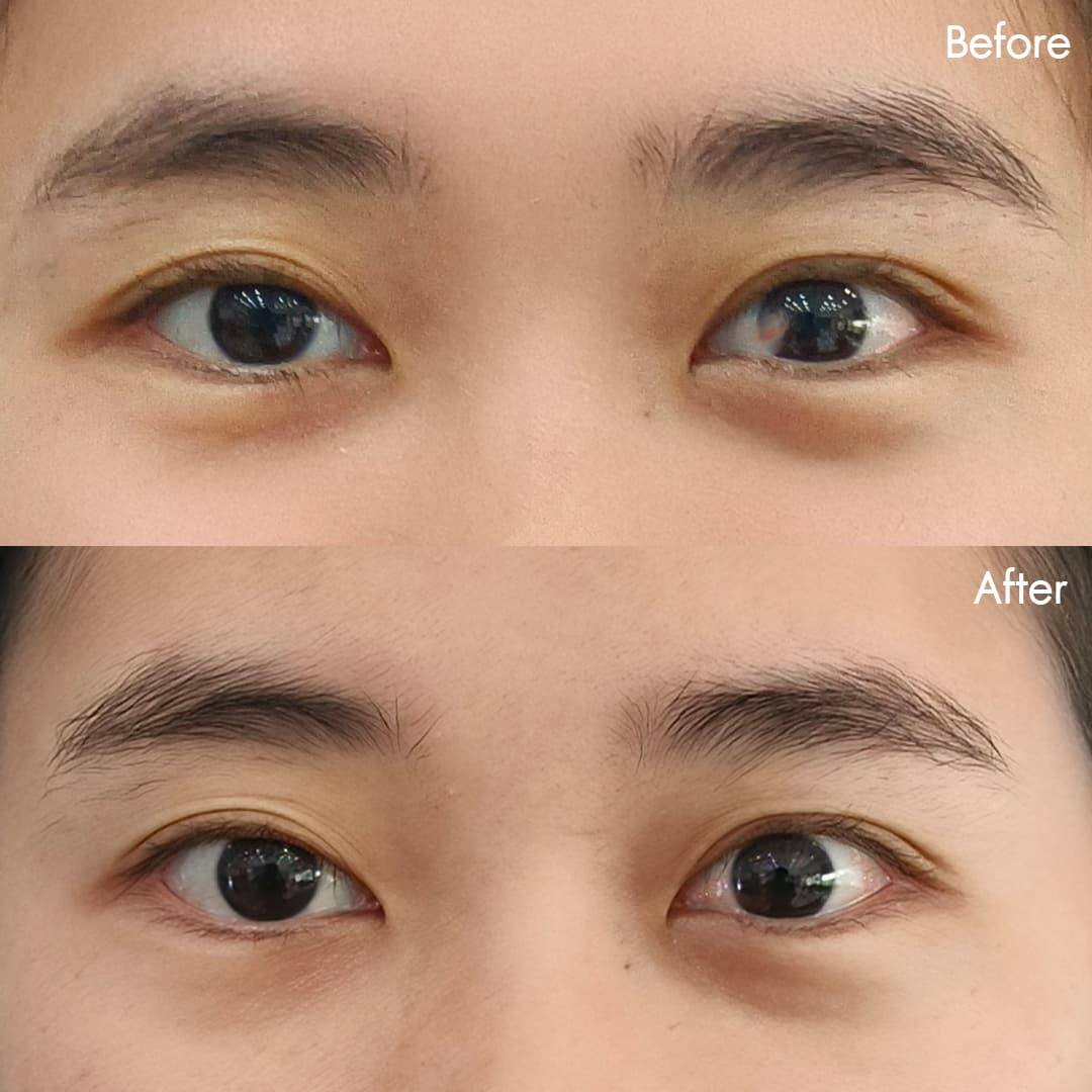 Before&After ลอกต้อเนื้อ(ว่าน)