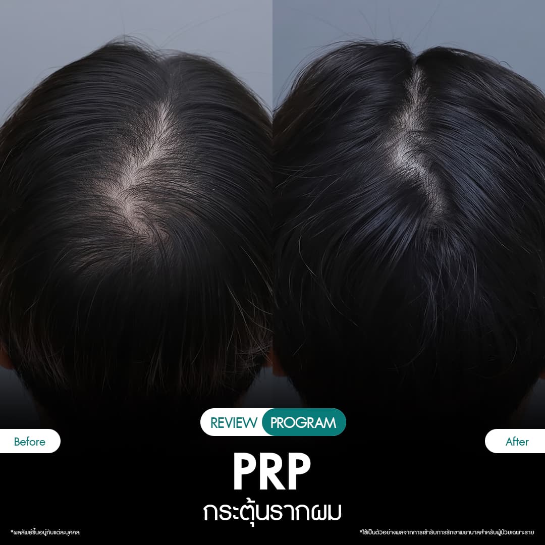 รีวิว ปลูกผม PRP 09