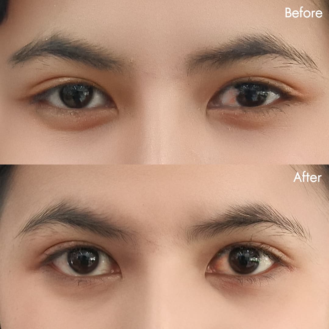 Before&After ลอกต้อเนื้อ(เมษา)