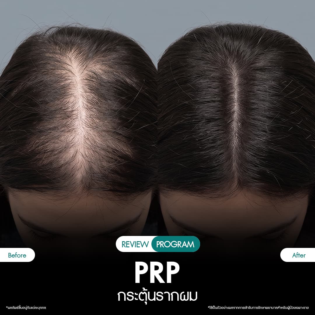 รีวิว ปลูกผม PRP 09