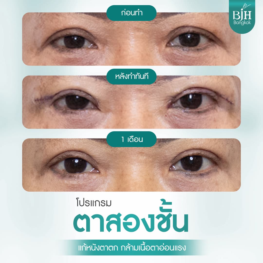 ตาสองชั้น 05