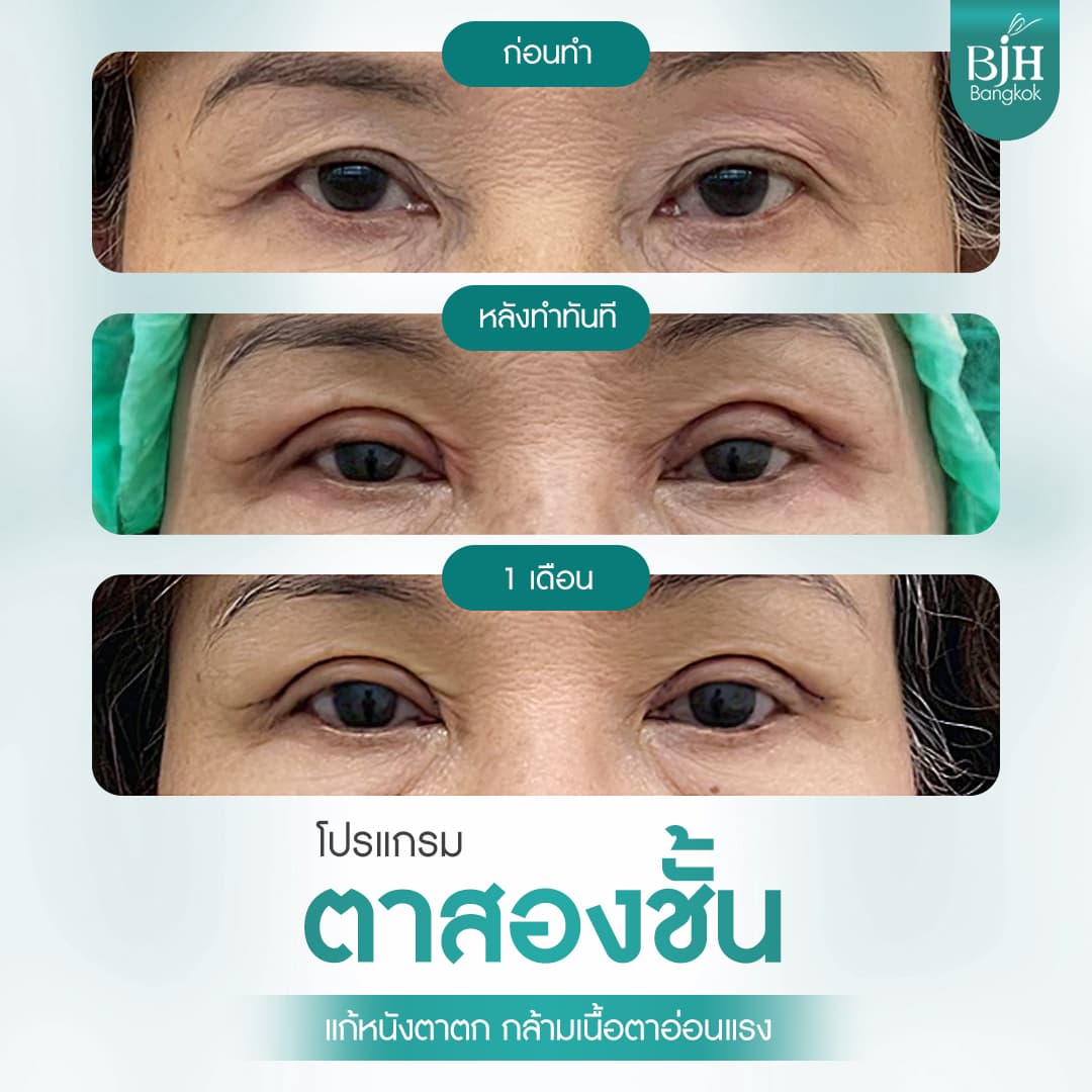 ตาสองชั้น 14