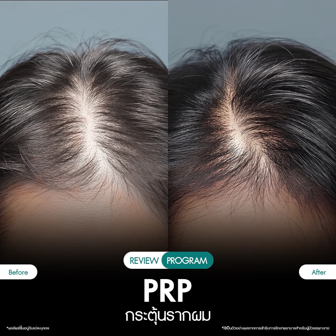 รีวิว ปลูกผม PRP 01