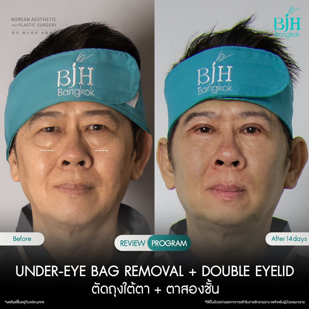 ตัดถุงใต้ตา2