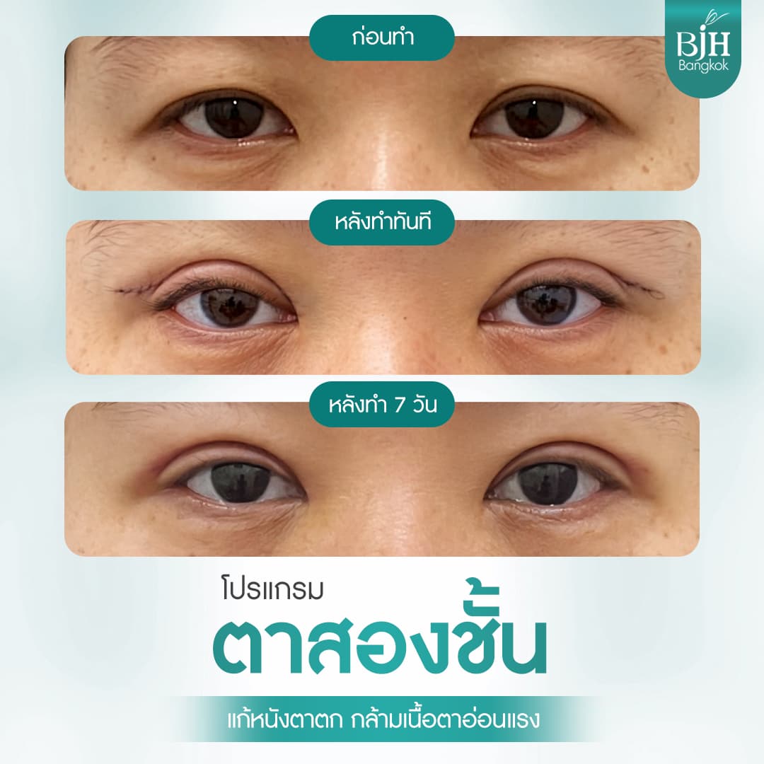 ตาสองชั้น 17