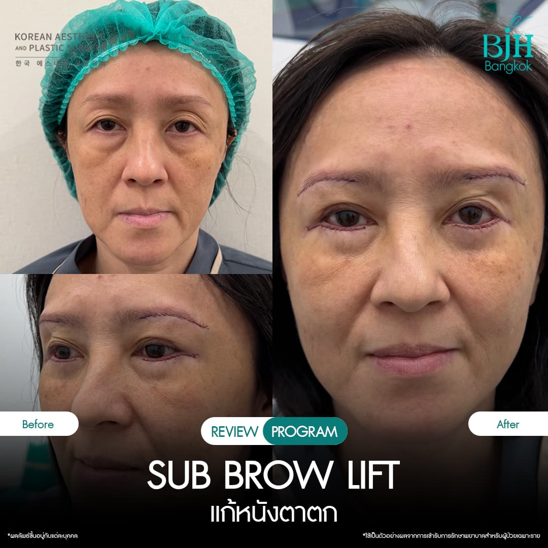 รีวิว Subbrowlift 10