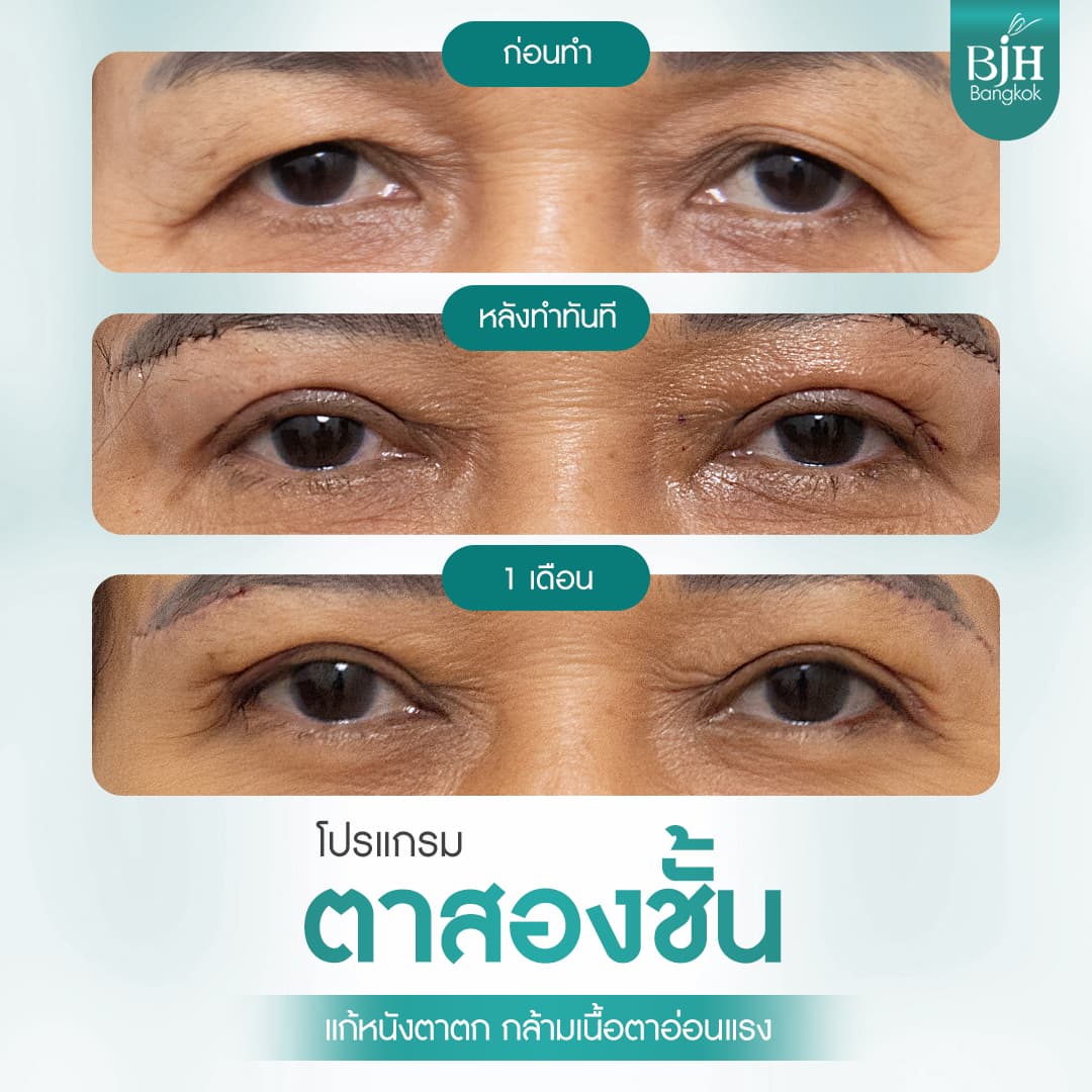 ตาสองชั้น 01