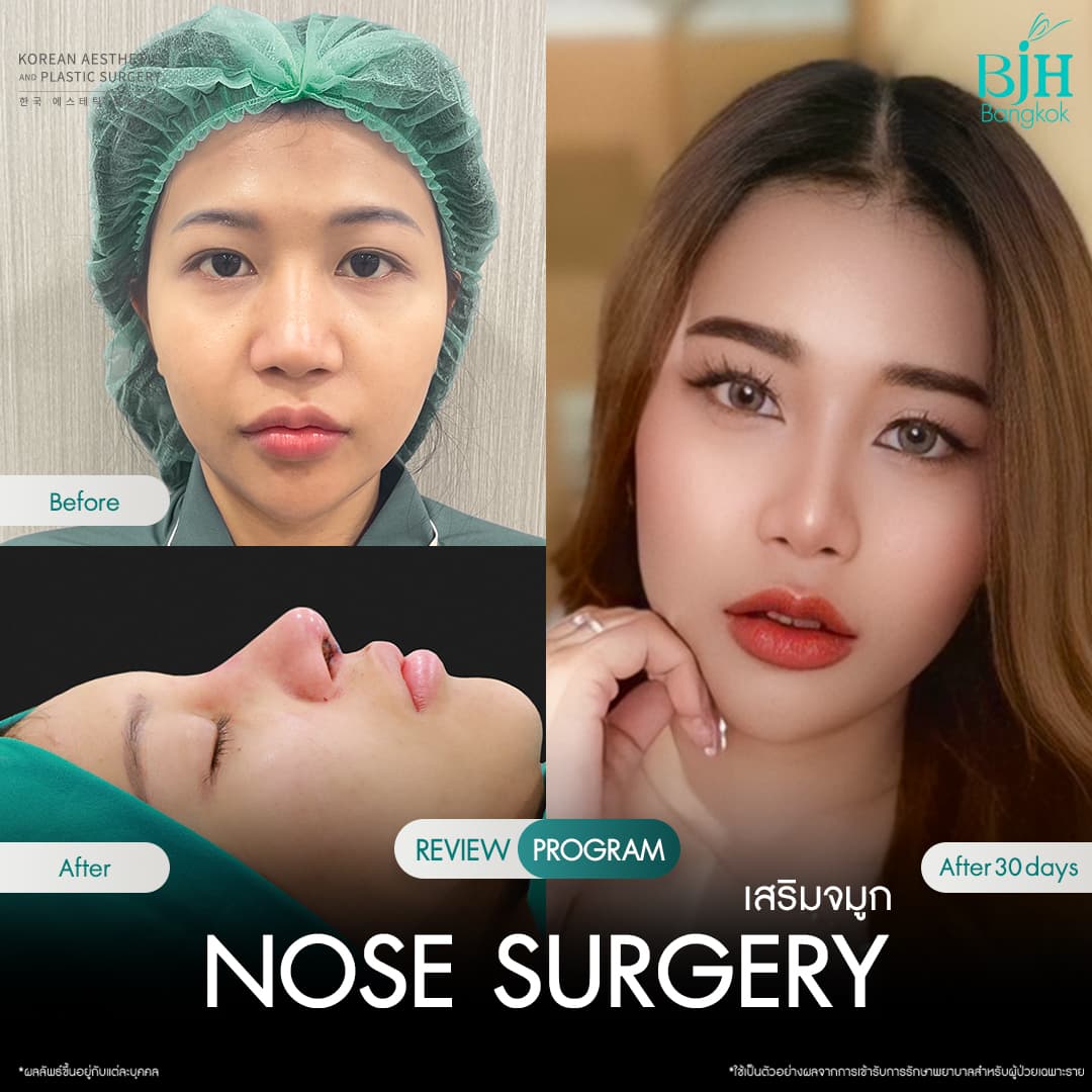 รีวิวเสริมจมูก 4