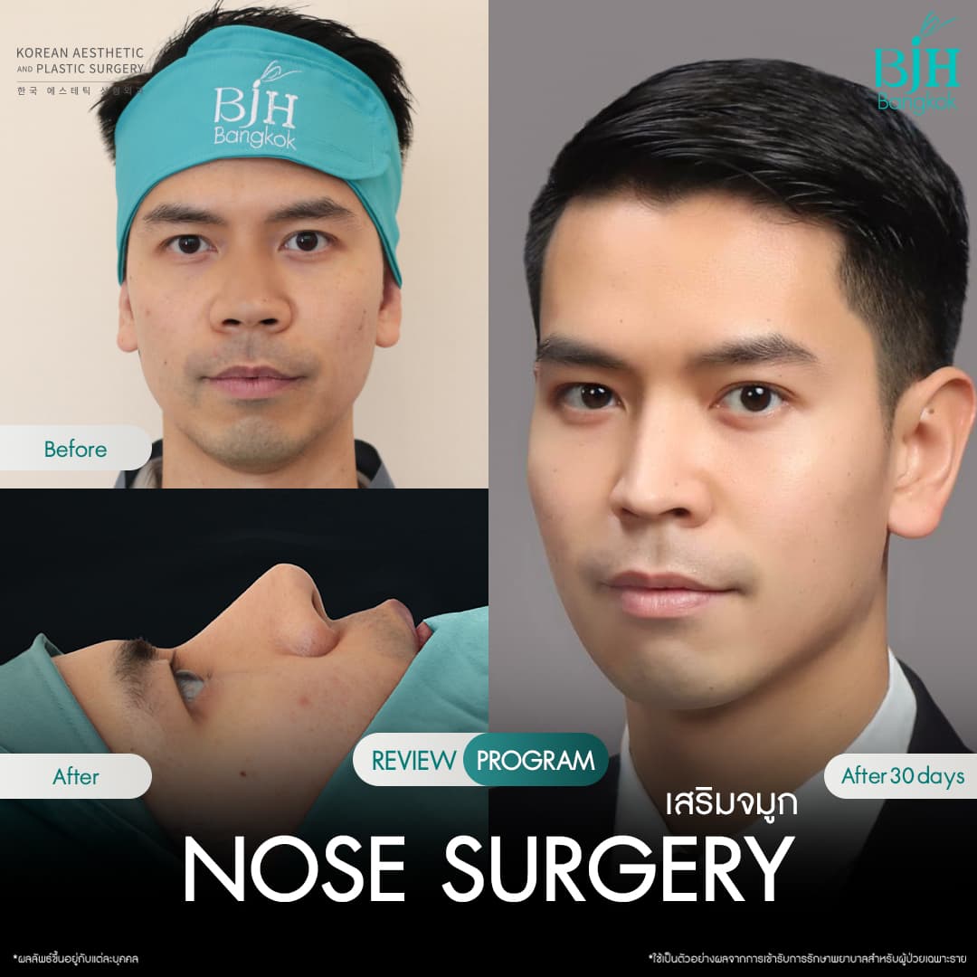 รีวิวเสริมจมูก 13