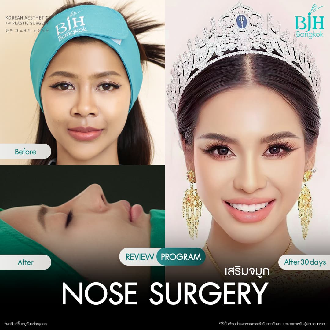 รีวิวเสริมจมูก 15