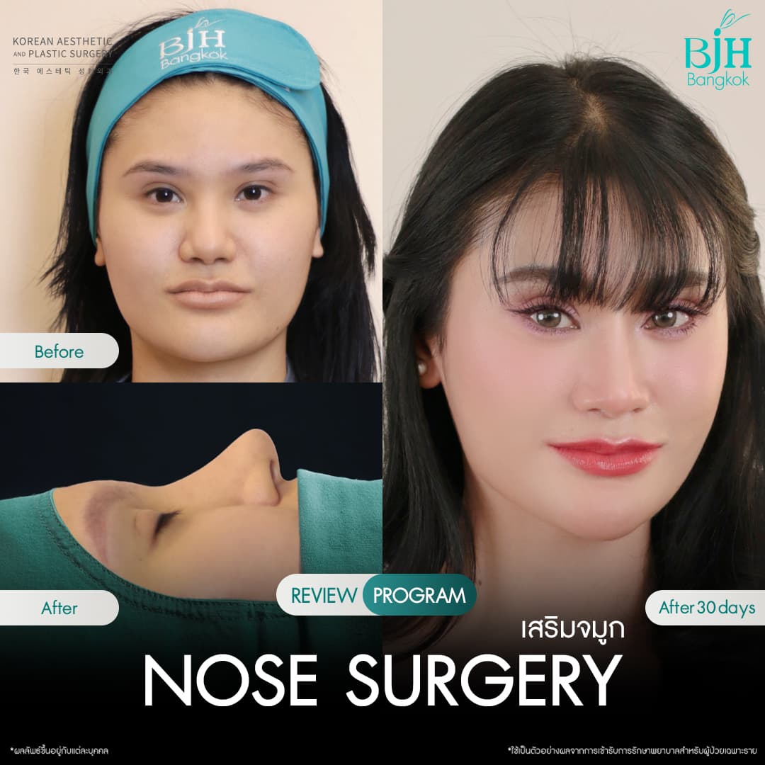รีวิวเสริมจมูก 19