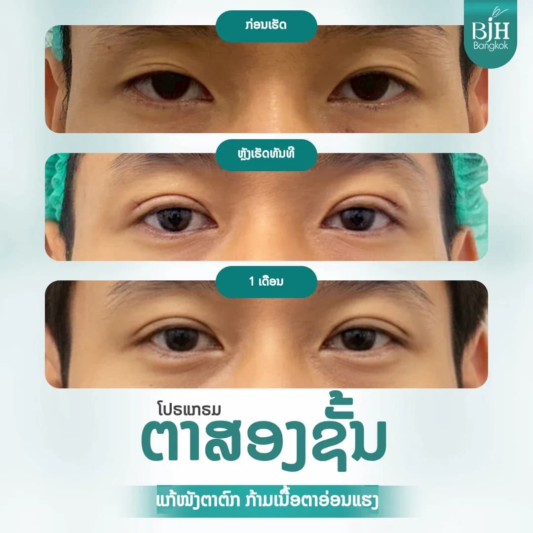 ตาสองชั้น 15