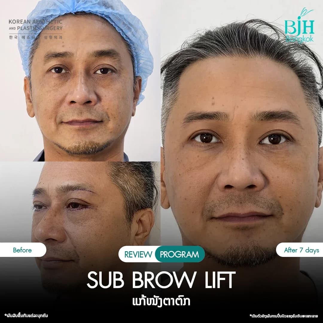 รีวิว Subbrowlift 02