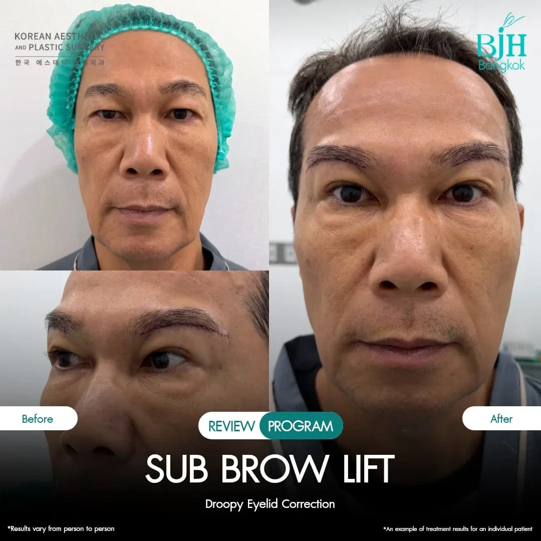 รีวิว Subbrowlift 11