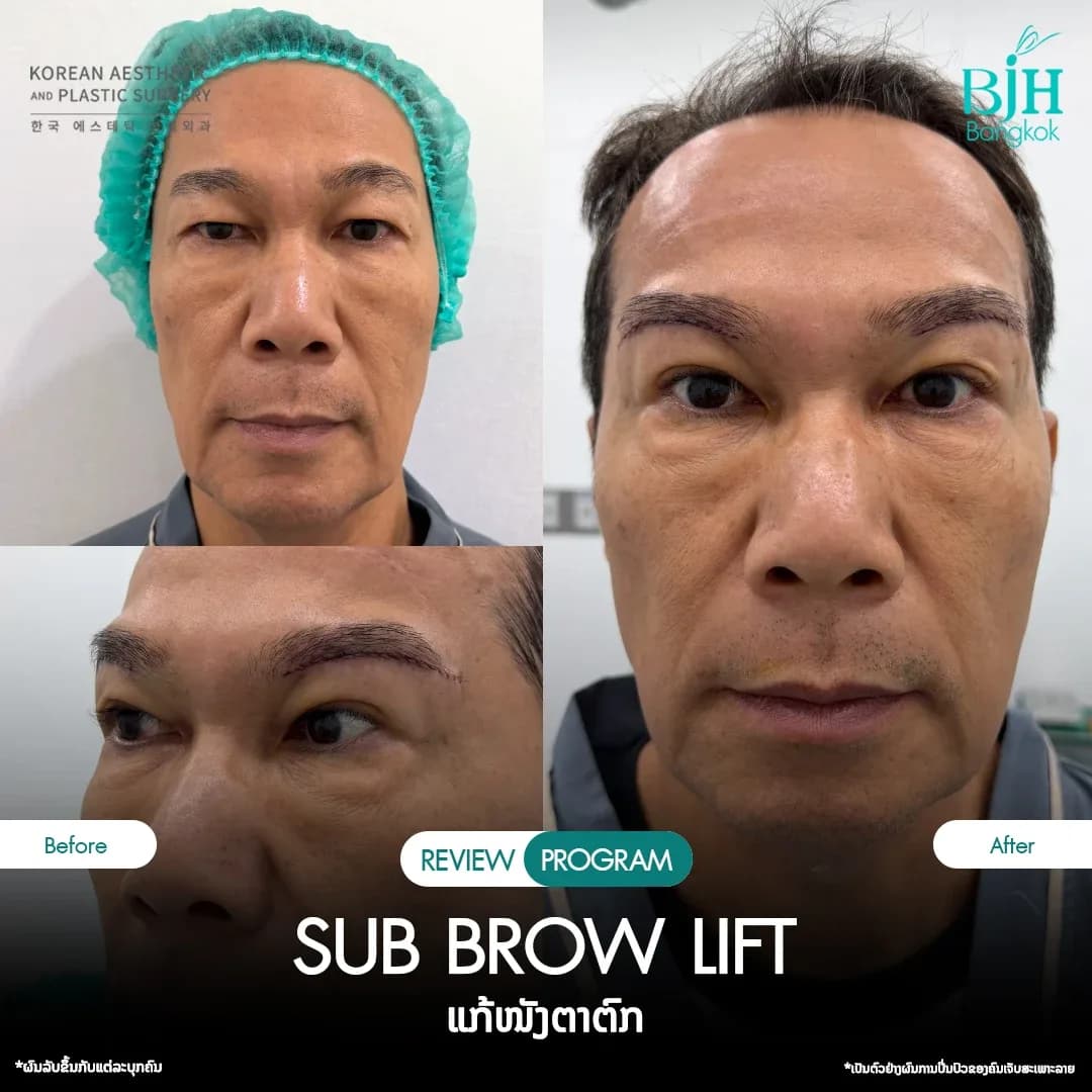 รีวิว Subbrowlift 11