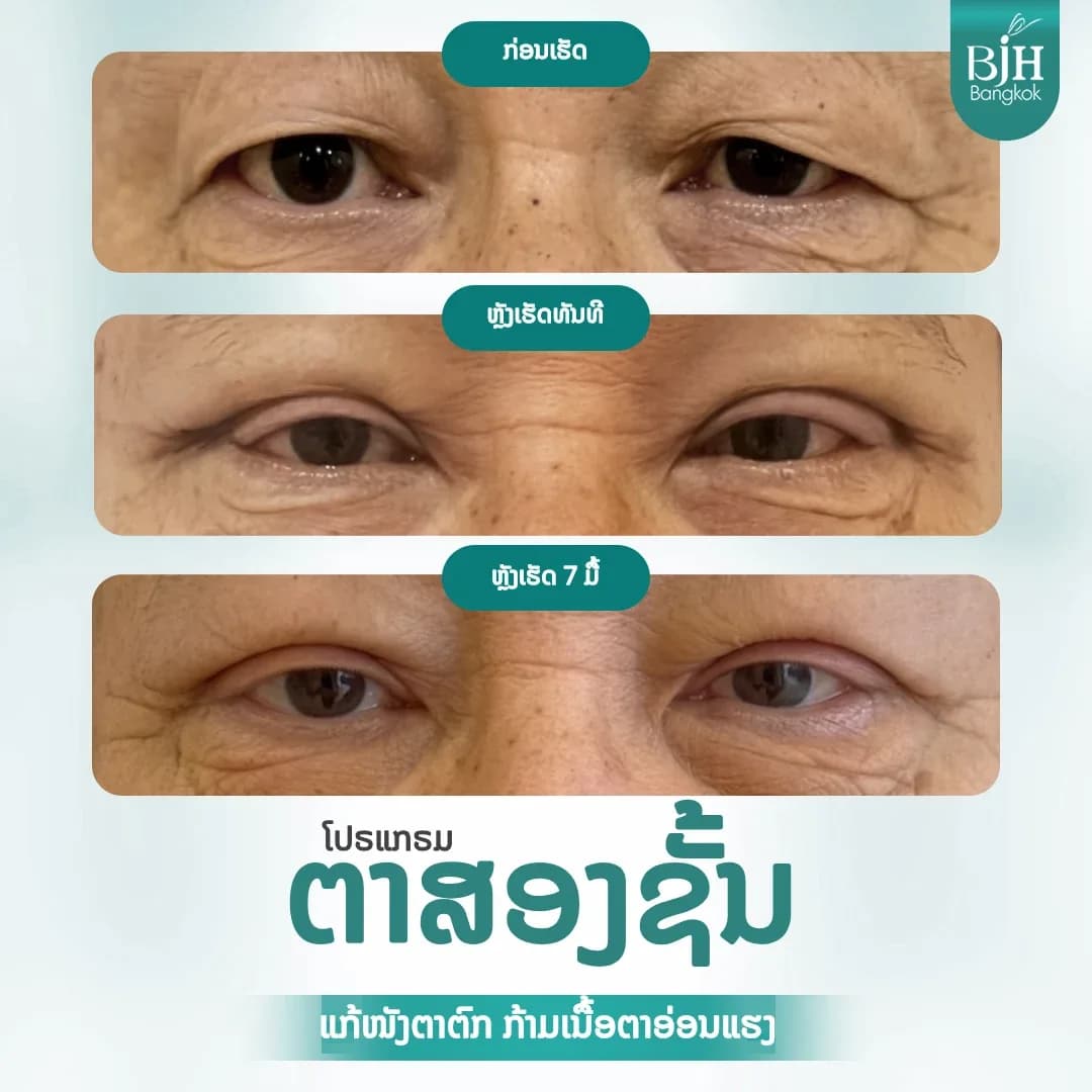ตาสองชั้น 18