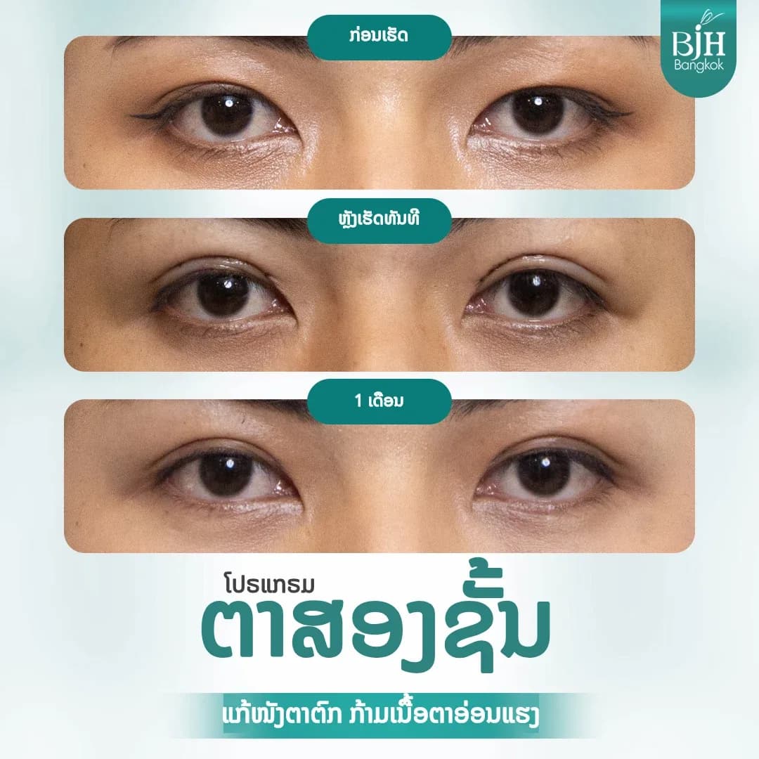 ตาสองชั้น 02